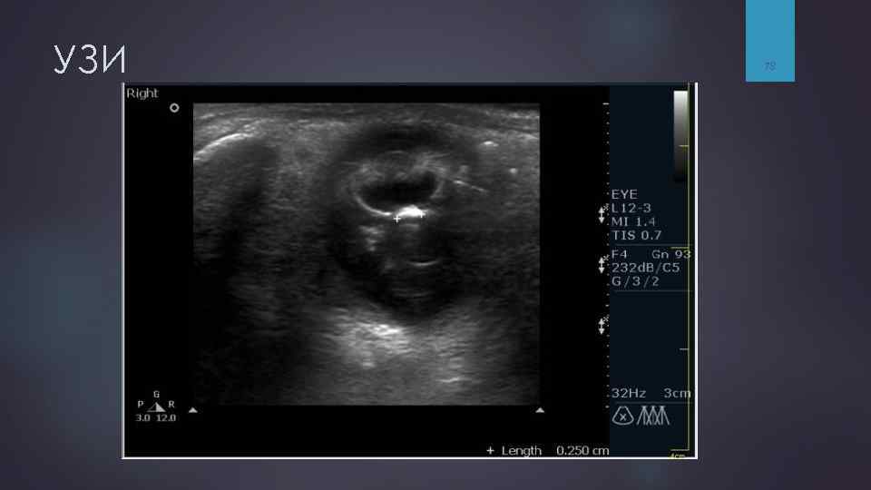 УЗИ 78 