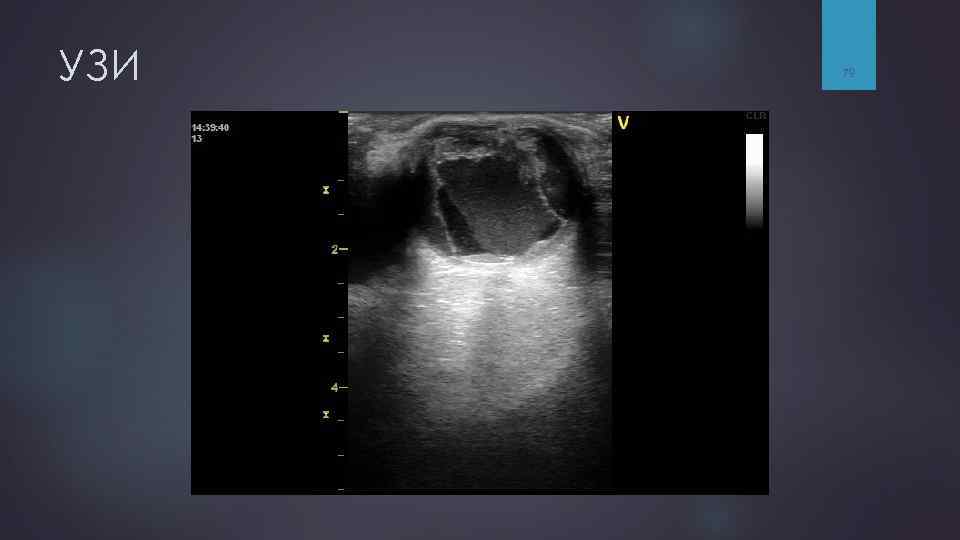УЗИ 79 