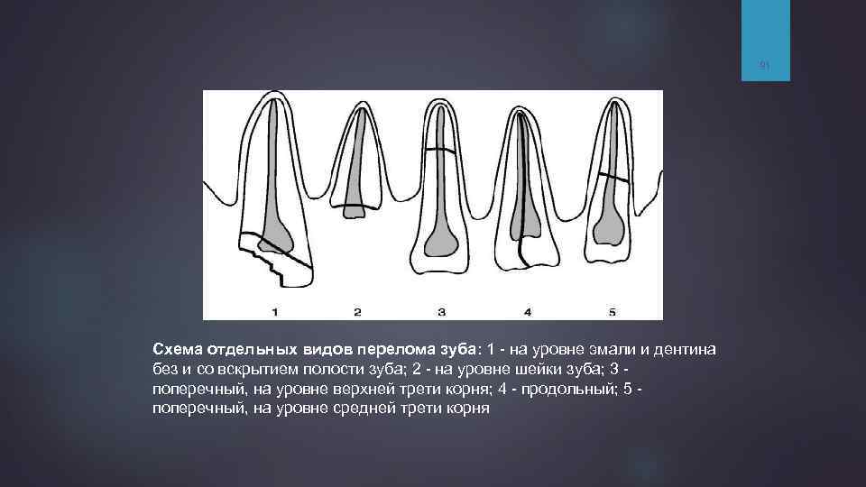 91 Схема отдельных видов перелома зуба: 1 - на уровне эмали и дентина без