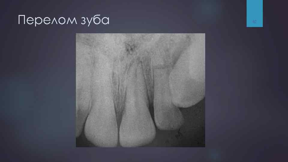 Перелом зуба 92 