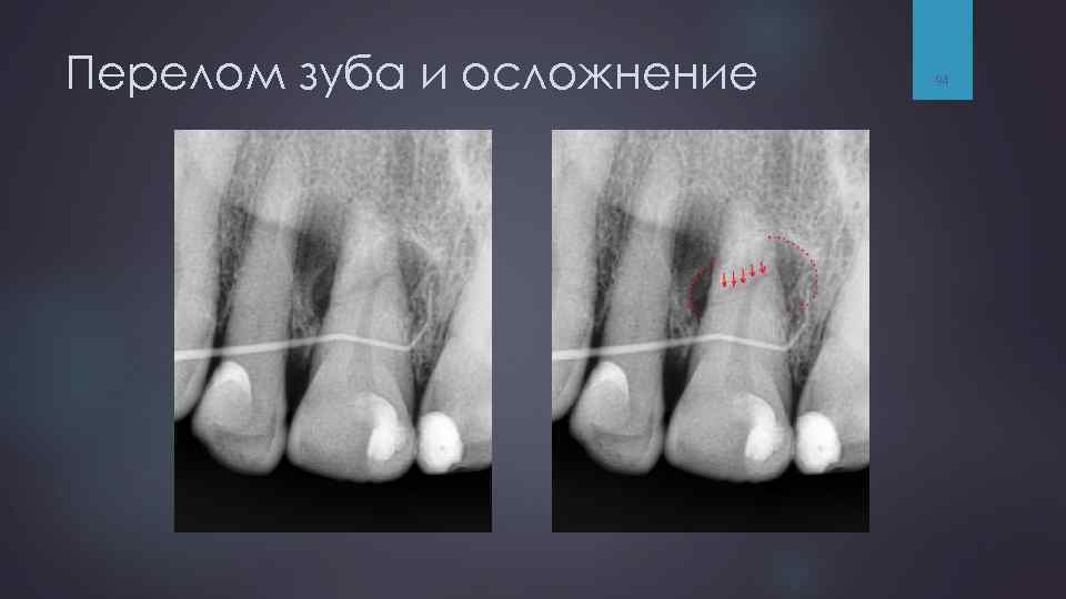 Перелом зуба и осложнение 94 