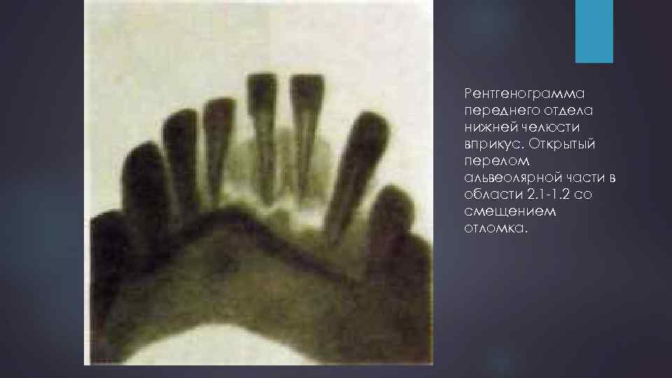 Рентгенограмма переднего отдела нижней челюсти вприкус. Открытый перелом альвеолярной части в области 2. 1