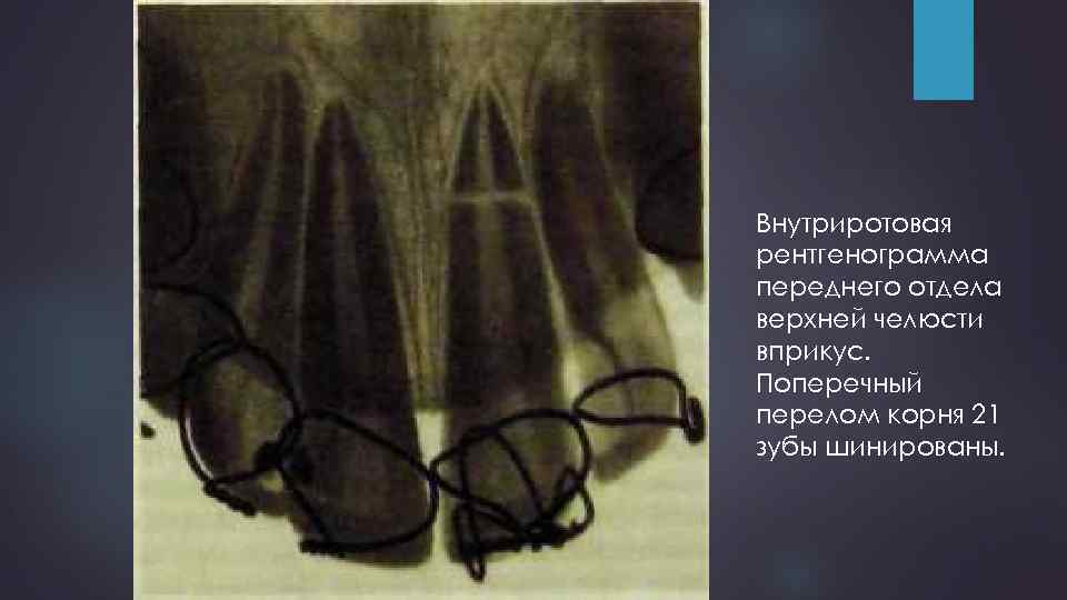 Внутриротовая рентгенограмма переднего отдела верхней челюсти вприкус. Поперечный перелом корня 21 зубы шинированы. 