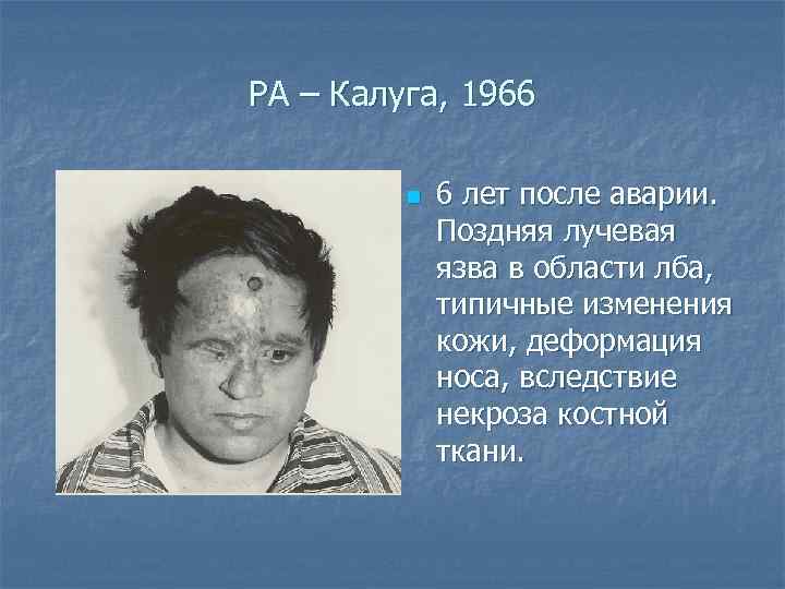 РА – Калуга, 1966 n 6 лет после аварии. Поздняя лучевая язва в области