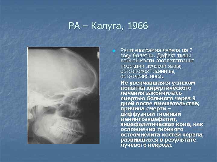 РА – Калуга, 1966 n Рентгенограмма черепа на 7 году болезни. Дефект ткани лобной