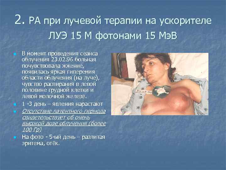 2. РА при лучевой терапии на ускорителе ЛУЭ 15 М фотонами 15 Мэ. В