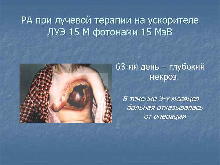 РА при лучевой терапии на ускорителе ЛУЭ 15 М фотонами 15 Мэ. В 63