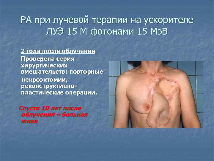 РА при лучевой терапии на ускорителе ЛУЭ 15 М фотонами 15 Мэ. В 2