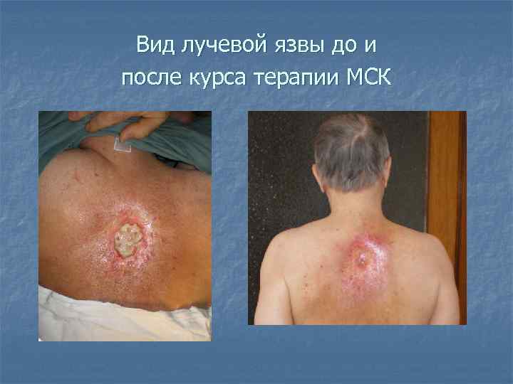 Вид лучевой язвы до и после курса терапии МСК 