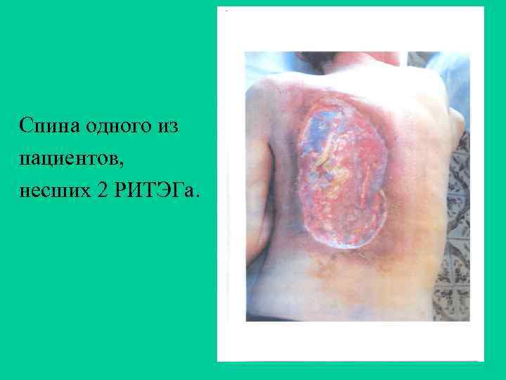 Спина одного из пациентов, несших 2 РИТЭГа. 