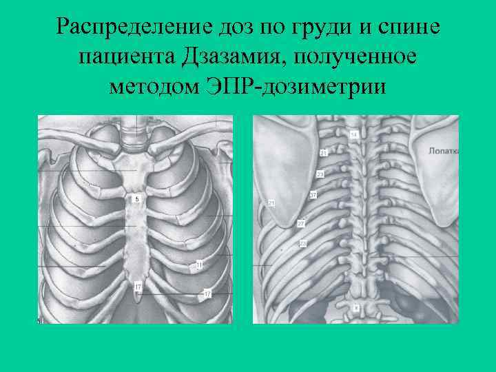 Распределение доз по груди и спине пациента Дзазамия, полученное методом ЭПР-дозиметрии 