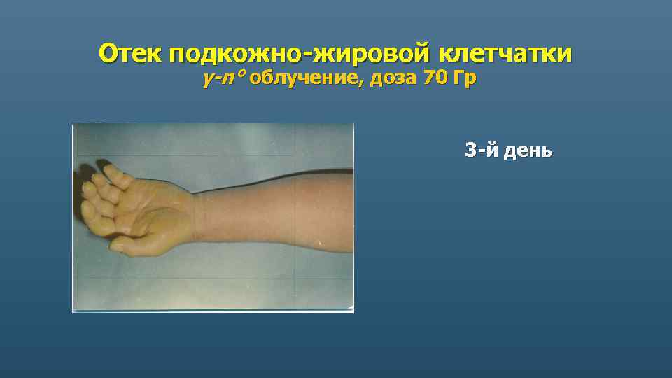 Отек подкожно-жировой клетчатки γ-n° облучение, доза 70 Гр 3 -й день 