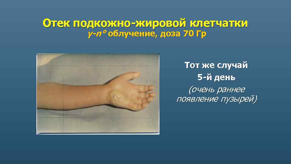 Отек подкожно-жировой клетчатки γ-n° облучение, доза 70 Гр Тот же случай 5 -й день