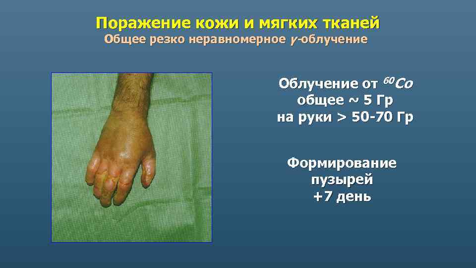 Поражение кожи и мягких тканей Общее резко неравномерное γ-облучение Облучение от 60 Co общее