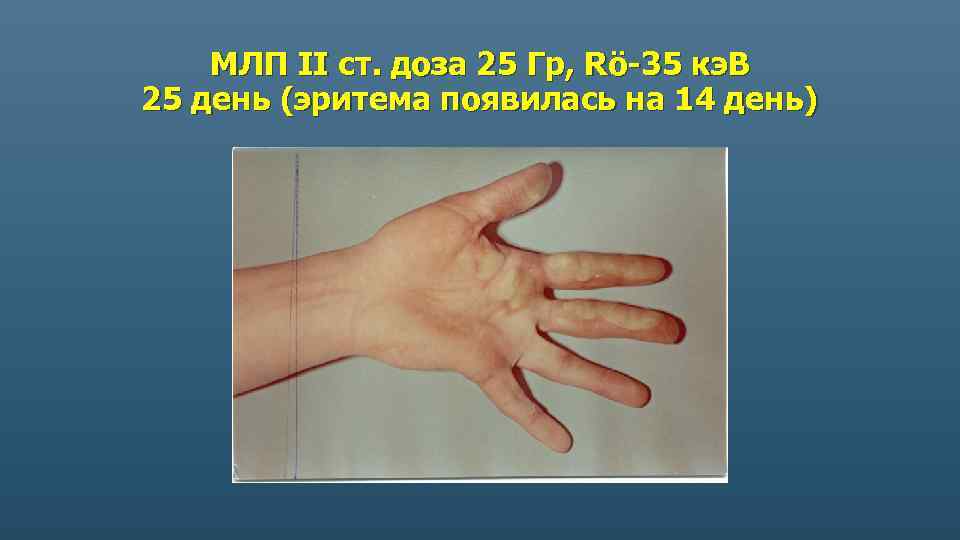 МЛП II ст. доза 25 Гр, Rö-35 кэ. В 25 день (эритема появилась на