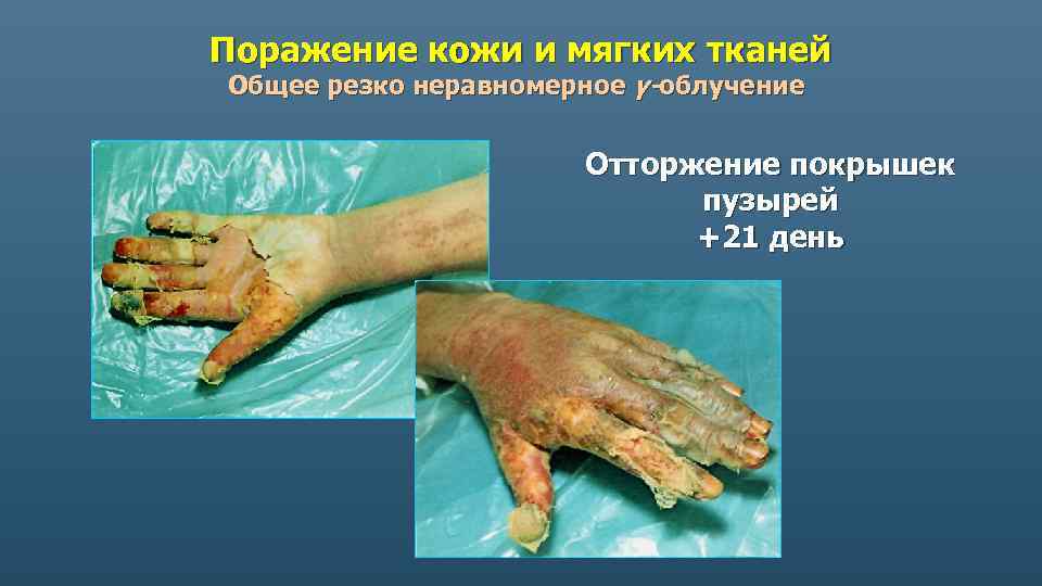 Поражение кожи и мягких тканей Общее резко неравномерное γ-облучение Отторжение покрышек пузырей +21 день
