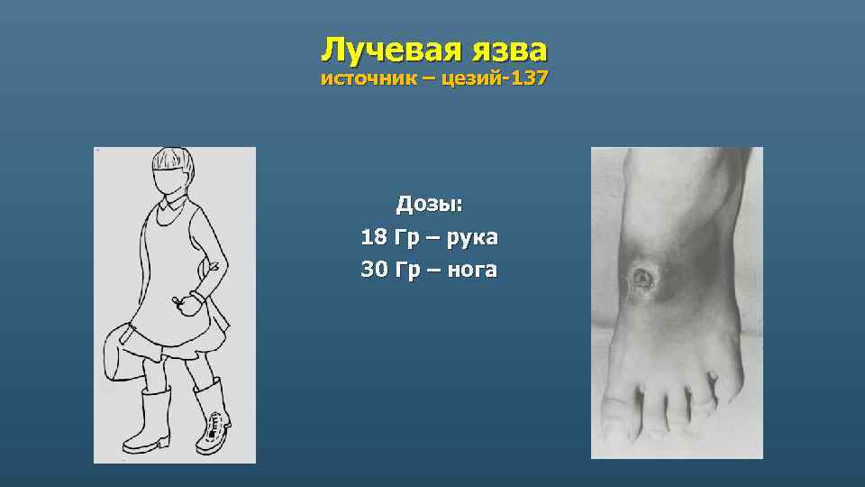Лучевая язва источник – цезий-137 Дозы: 18 Гр – рука 30 Гр – нога