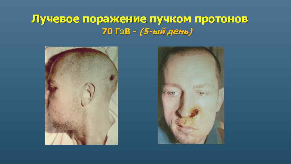 Лучевое поражение пучком протонов 70 Гэ. В - (5 -ый день) 