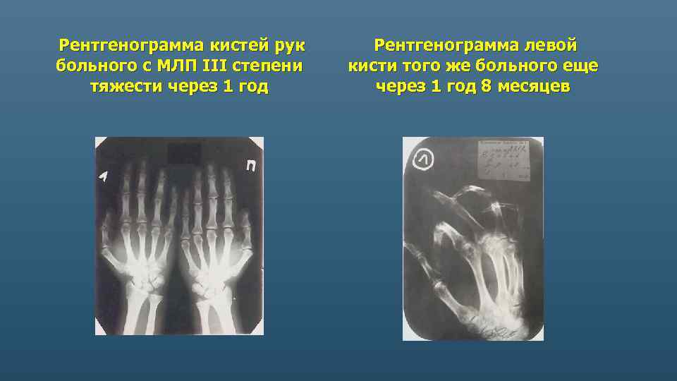 Рентгенограмма кистей рук больного с МЛП III степени тяжести через 1 год Рентгенограмма левой