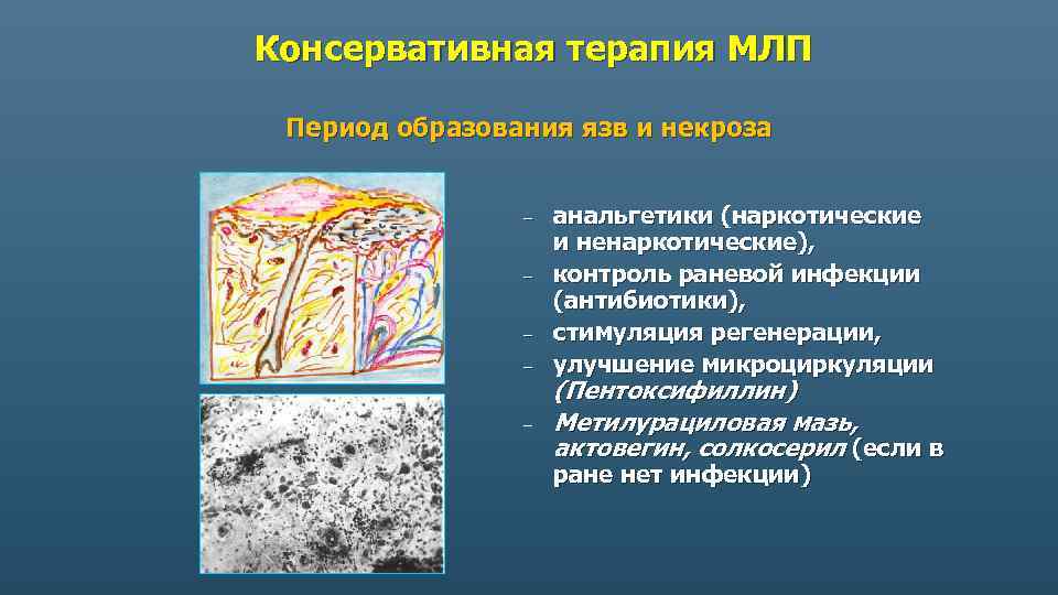 Консервативная терапия МЛП Период образования язв и некроза – – – анальгетики (наркотические и