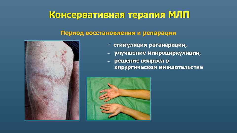 Консервативная терапия МЛП Период восстановления и репарации - стимуляция регенерации, – – улучшение микроциркуляции,