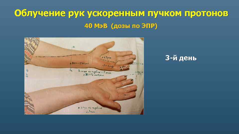 Облучение рук ускоренным пучком протонов 40 Мэ. В (дозы по ЭПР) 3 -й день