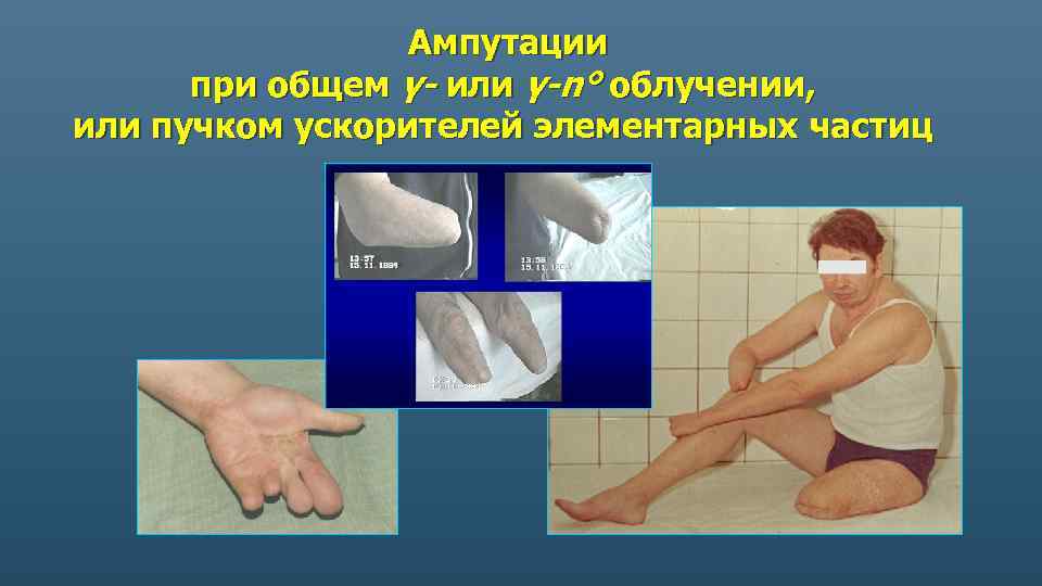Ампутации при общем γ- или γ-n° облучении, или пучком ускорителей элементарных частиц 