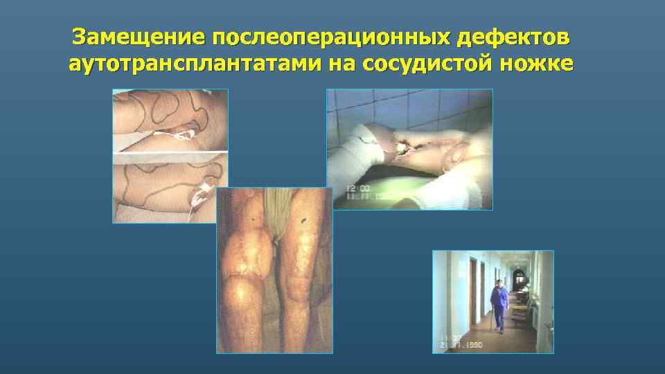 Замещение послеоперационных дефектов аутотрансплантатами на сосудистой ножке 