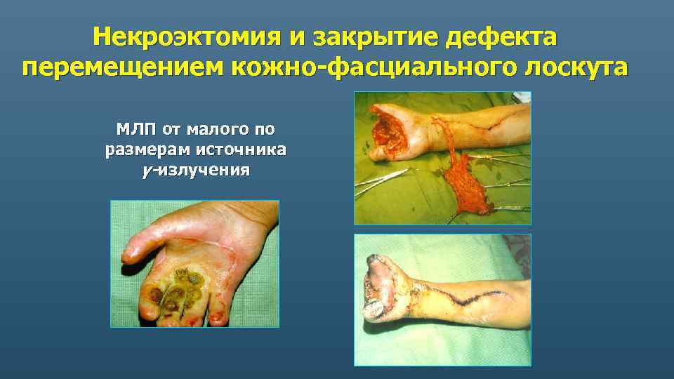 Некроэктомия и закрытие дефекта перемещением кожно-фасциального лоскута МЛП от малого по размерам источника γ-излучения