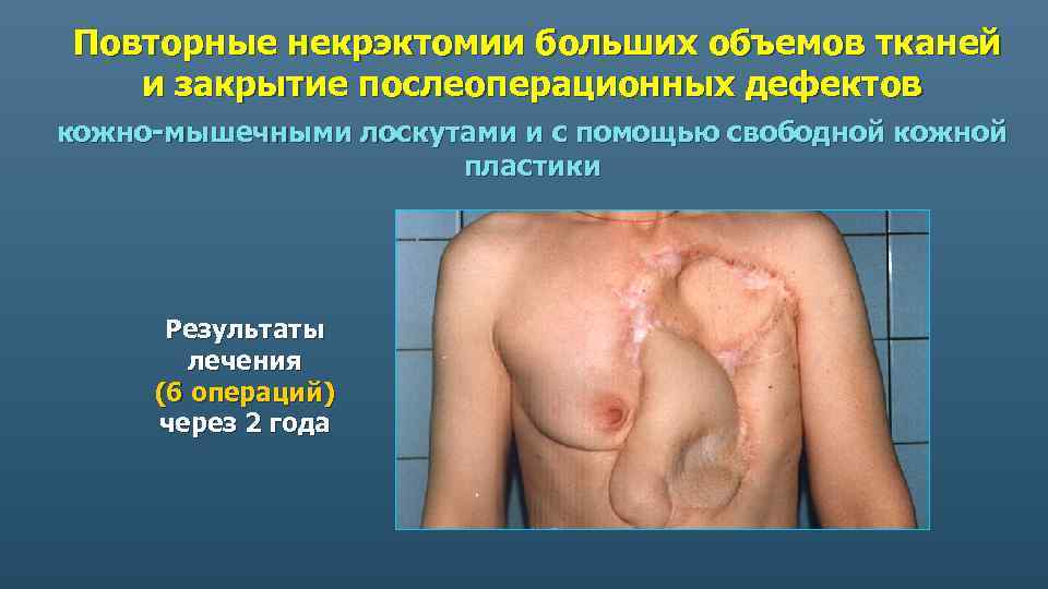 Повторные некрэктомии больших объемов тканей и закрытие послеоперационных дефектов кожно-мышечными лоскутами и с помощью