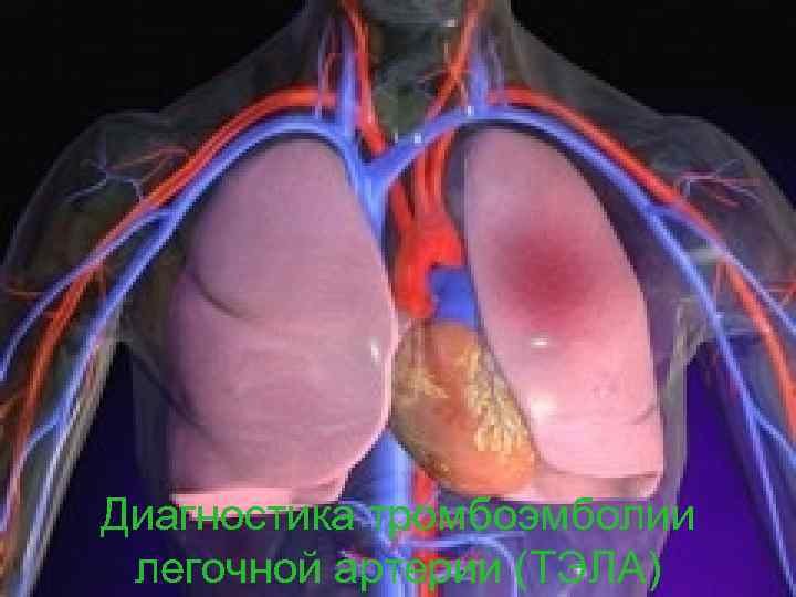 Диагностика тромбоэмболии легочной артерии (ТЭЛА) 