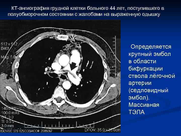  КТ-ангиография грудной клетки больного 44 лет, поступившего в полуобморочном состоянии с жалобами на