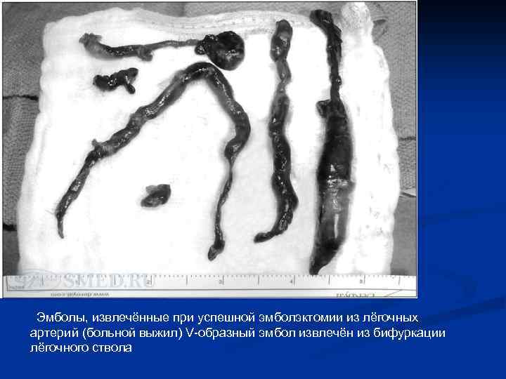 Эмболы, извлечённые при успешной эмболэктомии из лёгочных артерий (больной выжил) V-образный эмбол извлечён из