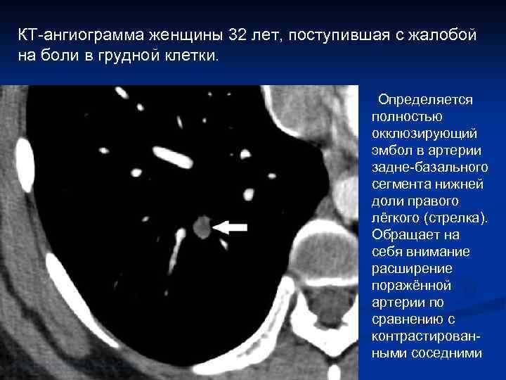 КТ-ангиограмма женщины 32 лет, поступившая с жалобой на боли в грудной клетки. Определяется полностью