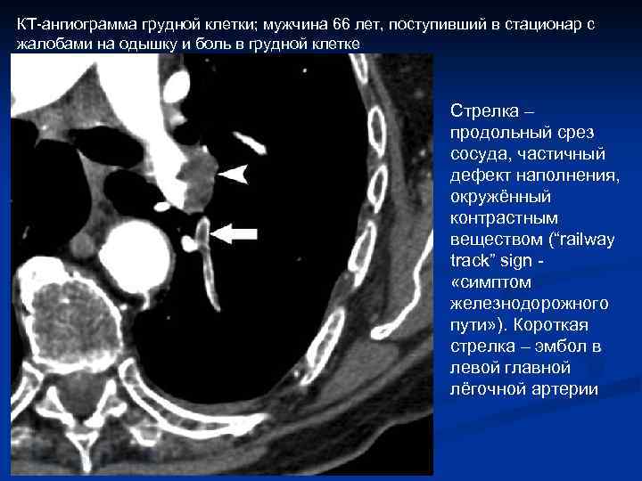 КТ-ангиограмма грудной клетки; мужчина 66 лет, поступивший в стационар с жалобами на одышку и