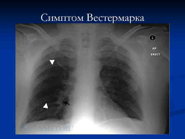 Симптом Вестермарка 