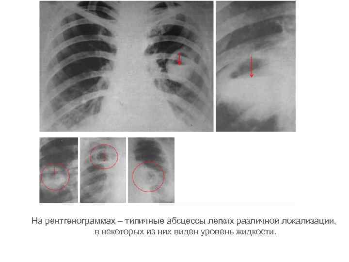 На рентгенограммах – типичные абсцессы легких различной локализации, в некоторых из них виден уровень
