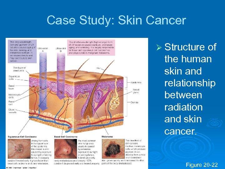 Case Study: Skin Cancer Ø Structure of the human skin and relationship between radiation