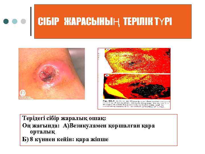 СІБІР ЖАРАСЫНЫҢ ТЕРІЛІК ТҮРІ Терідегі сібір жаралық ошақ: Оң жағында: А)Везикуламен қоршалған қара орталық