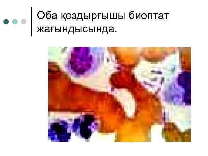 Оба қоздырғышы биоптат жағындысында. 