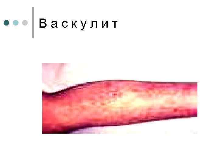Васкулит 