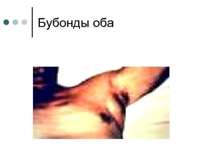 Бубонды оба 