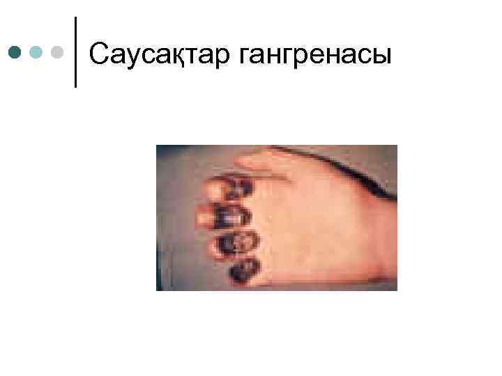 Саусақтар гангренасы 