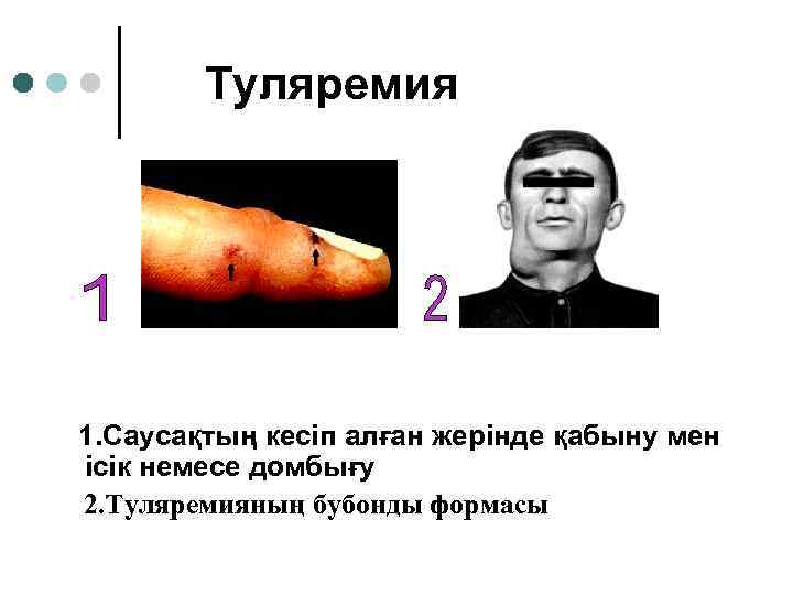 Туляремия 1. Саусақтың кесіп алған жерінде қабыну мен ісік немесе домбығу 2. Туляремияның бубонды