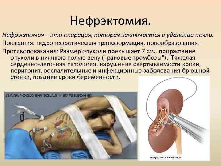 Нефрэктомия – это операция, которая заключается в удалении почки. Показания: гидронефротическая трансформация, новообразования. Противопоказания: