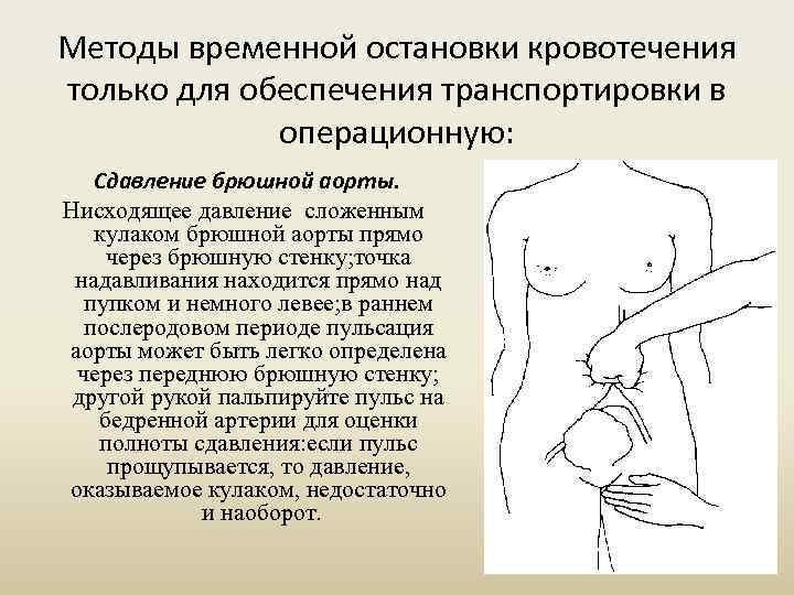 Методы временной остановки кровотечения только для обеспечения транспортировки в операционную: Сдавление брюшной аорты. Нисходящее