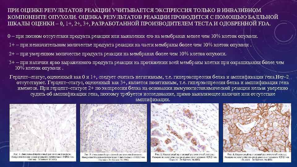 ПРИ ОЦЕНКЕ РЕЗУЛЬТАТОВ РЕАКЦИИ УЧИТЫВАЕТСЯ ЭКСПРЕССИЯ ТОЛЬКО В ИНВАЗИВНОМ КОМПОНЕНТЕ ОПУХОЛИ. ОЦЕНКА РЕЗУЛЬТАТОВ РЕАКЦИИ