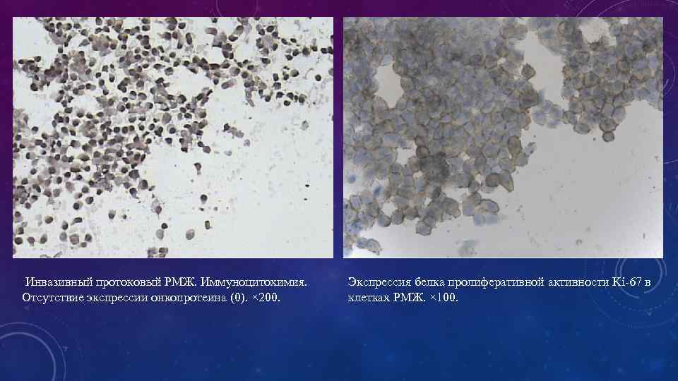 Инвазивный протоковый РМЖ. Иммуноцитохимия. Отсутствие экспрессии онкопротеина (0). × 200. Экспрессия белка пролиферативной активности