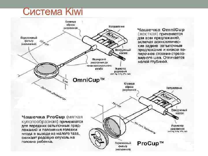 Вакуум экстракция плода