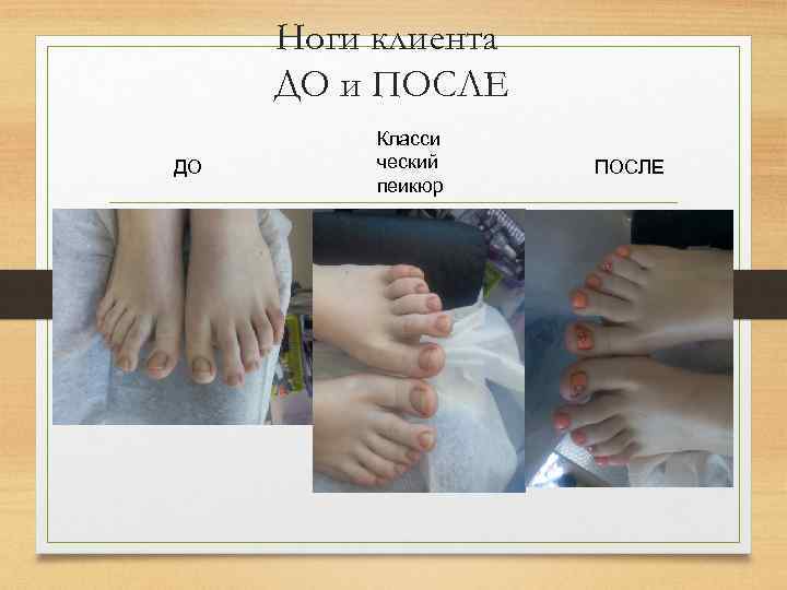 Ноги клиента ДО и ПОСЛЕ ДО Класси ческий пеикюр ПОСЛЕ 